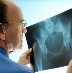 Osteoporosis in Seniors